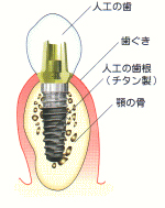 インプラントの材料は？