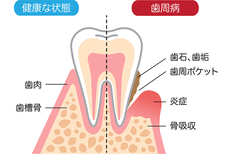 30才以上の方の約80％が罹患している歯周病